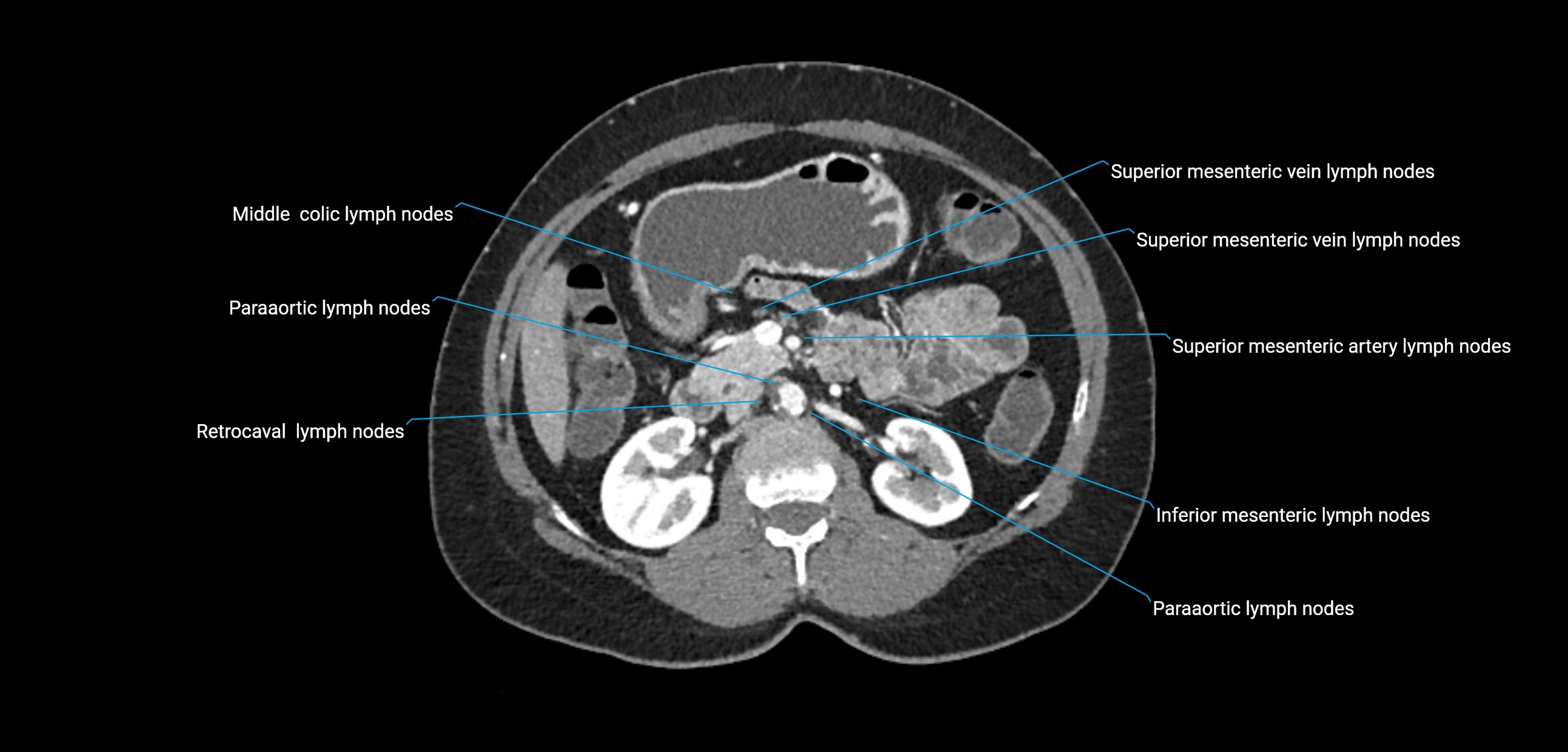 CT ct abdominal lymph nodes  axial cross sectional anatomy  enchanced radiology image -img-00002-00183.webp